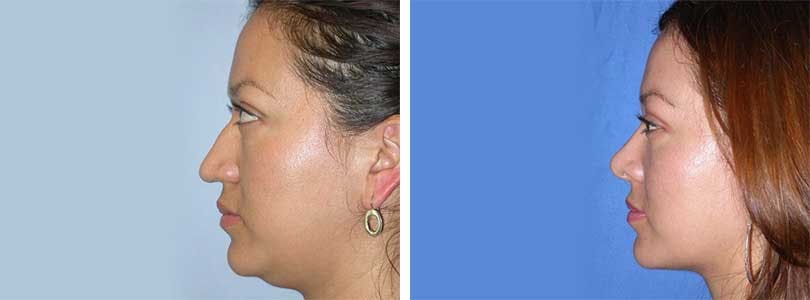Rhinoplasty Before & After Gallery - Patient 74275510 - Image 2