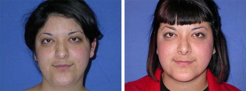 Rhinoplasty Before & After Gallery - Patient 74275512 - Image 1