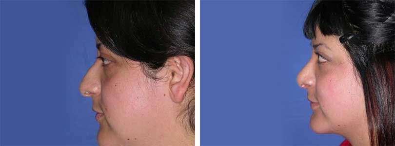 Rhinoplasty Before & After Gallery - Patient 74275512 - Image 2