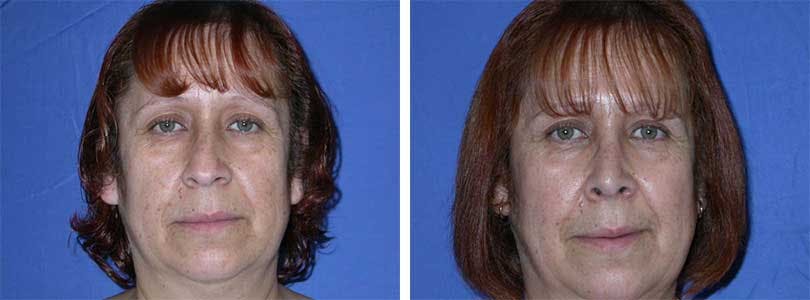 Rhinoplasty Before & After Gallery - Patient 74275513 - Image 1