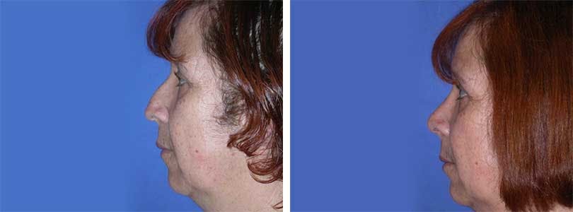 Rhinoplasty Before & After Gallery - Patient 74275513 - Image 2