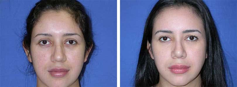 Rhinoplasty Before & After Gallery - Patient 74275514 - Image 1