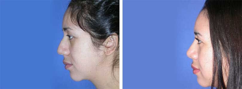 Rhinoplasty Before & After Gallery - Patient 74275514 - Image 2