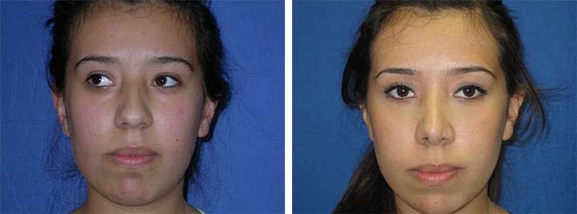 Rhinoplasty Before & After Gallery - Patient 74275515 - Image 1