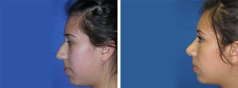 Rhinoplasty Before & After Gallery - Patient 74275515 - Image 2