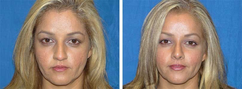 Rhinoplasty Before & After Gallery - Patient 74275516 - Image 1