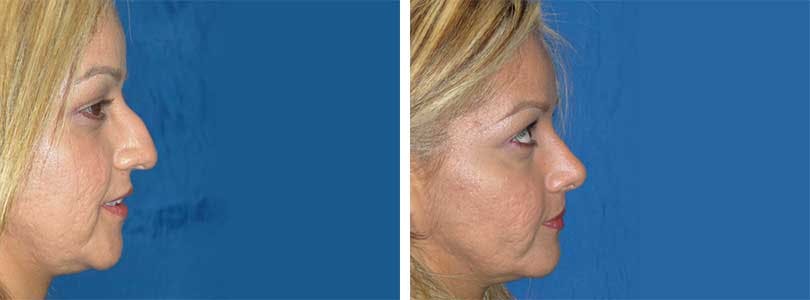 Rhinoplasty Before & After Gallery - Patient 74275516 - Image 2