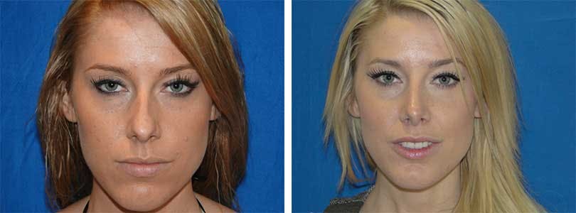 Rhinoplasty Before & After Gallery - Patient 74275524 - Image 1