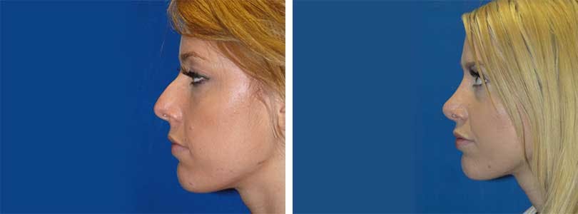 Rhinoplasty Before & After Gallery - Patient 74275524 - Image 2