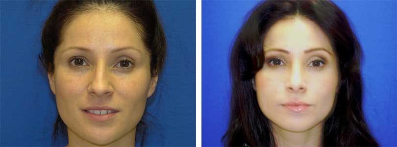 Rhinoplasty Before & After Gallery - Patient 74275525 - Image 1