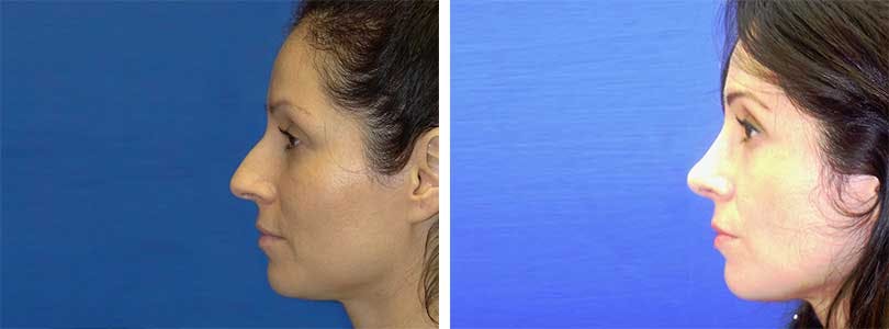 Rhinoplasty Before & After Gallery - Patient 74275525 - Image 2