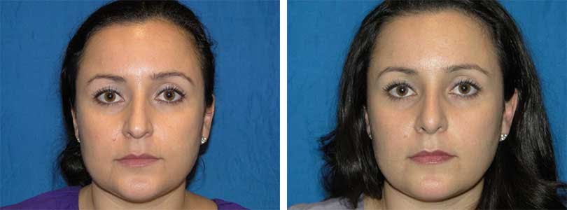 Rhinoplasty Before & After Gallery - Patient 74275526 - Image 1