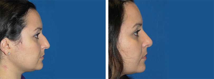 Rhinoplasty Before & After Gallery - Patient 74275526 - Image 2