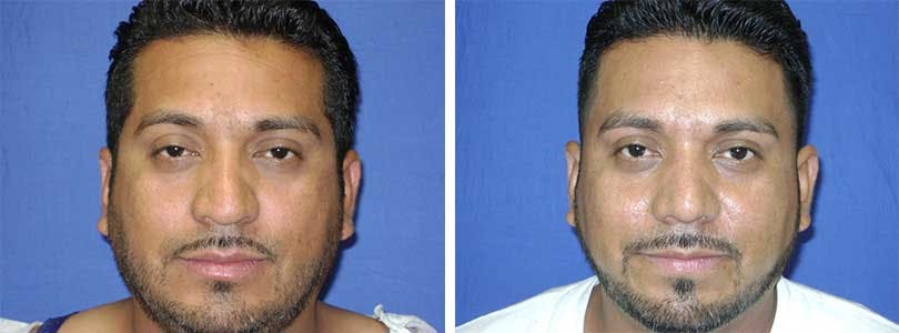 Rhinoplasty Before & After Gallery - Patient 74275527 - Image 1