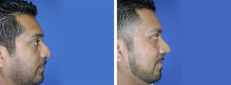 Rhinoplasty Before & After Gallery - Patient 74275527 - Image 2