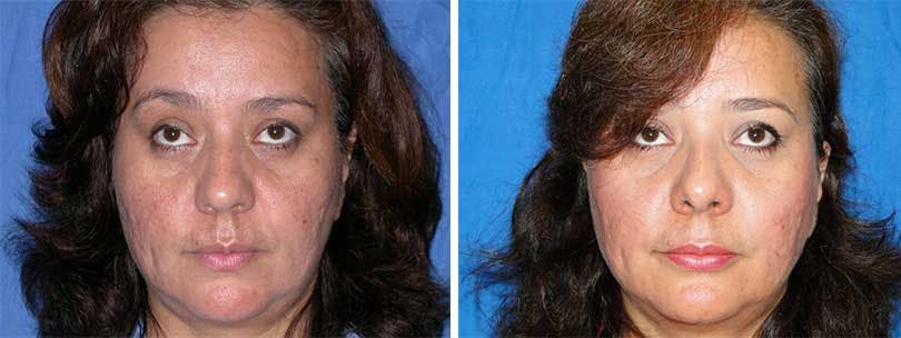 Rhinoplasty Before & After Gallery - Patient 74275528 - Image 1