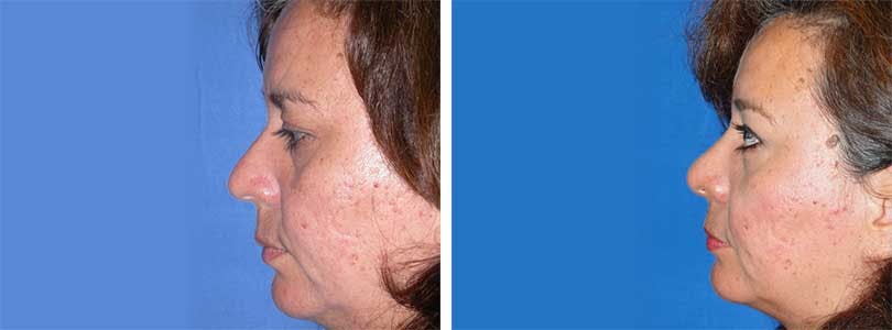 Rhinoplasty Before & After Gallery - Patient 74275528 - Image 2