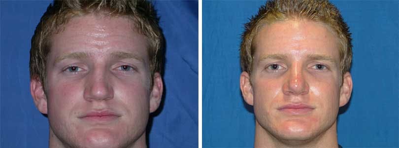 Rhinoplasty Before & After Gallery - Patient 74275531 - Image 1
