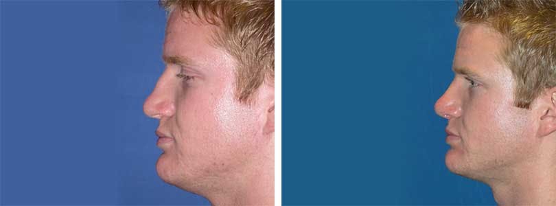 Rhinoplasty Before & After Gallery - Patient 74275531 - Image 2