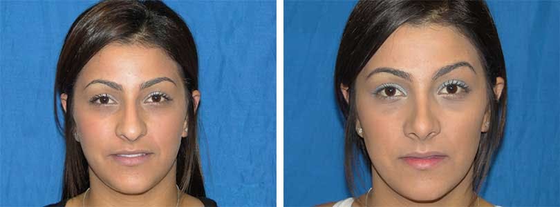 Rhinoplasty Before & After Gallery - Patient 74275532 - Image 1