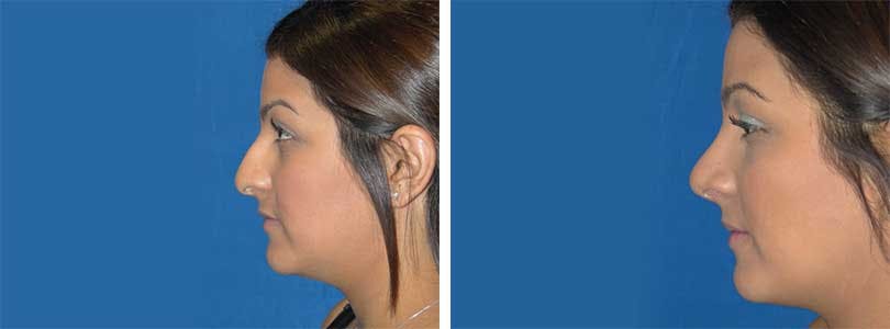 Rhinoplasty Before & After Gallery - Patient 74275532 - Image 2
