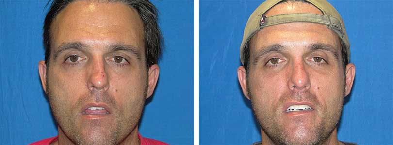 Rhinoplasty Before & After Gallery - Patient 74275533 - Image 1