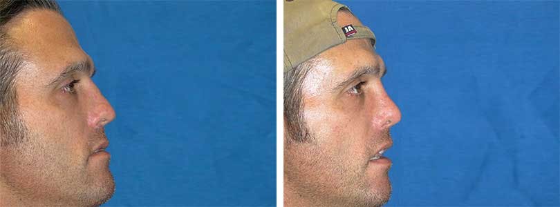 Rhinoplasty Before & After Gallery - Patient 74275533 - Image 2