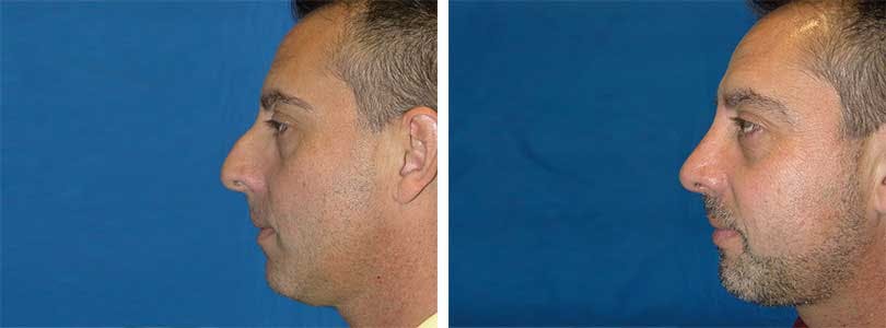 Rhinoplasty Before & After Gallery - Patient 74275534 - Image 1