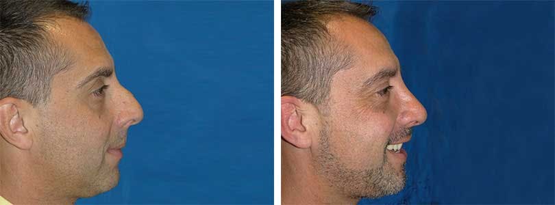 Rhinoplasty Before & After Gallery - Patient 74275534 - Image 2