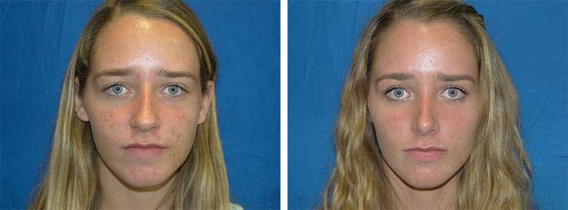 Rhinoplasty Before & After Gallery - Patient 74275535 - Image 1