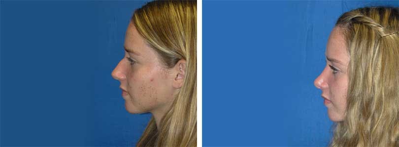 Rhinoplasty Before & After Gallery - Patient 74275535 - Image 2
