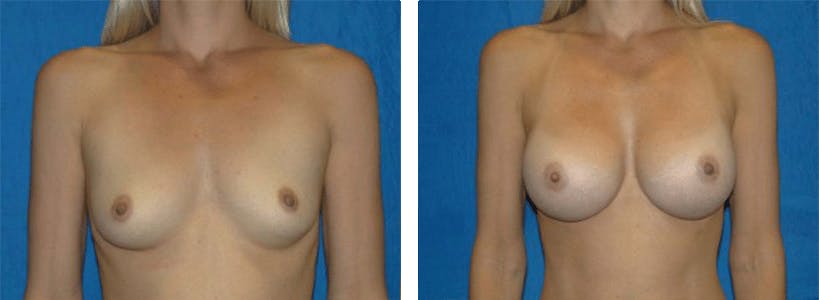 Breast Augmentation Before & After Gallery - Patient 74801779 - Image 1