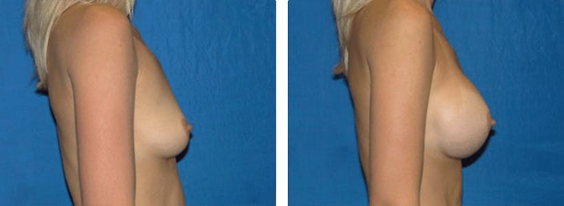 Breast Augmentation Before & After Gallery - Patient 74801779 - Image 2