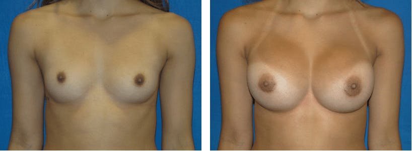 Breast Augmentation Before & After Gallery - Patient 74801780 - Image 1
