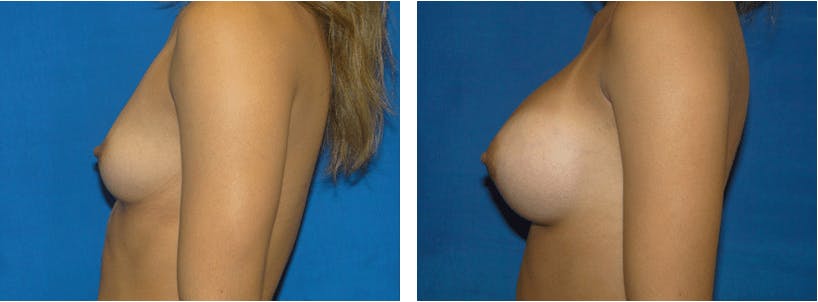Breast Augmentation Before & After Gallery - Patient 74801780 - Image 2