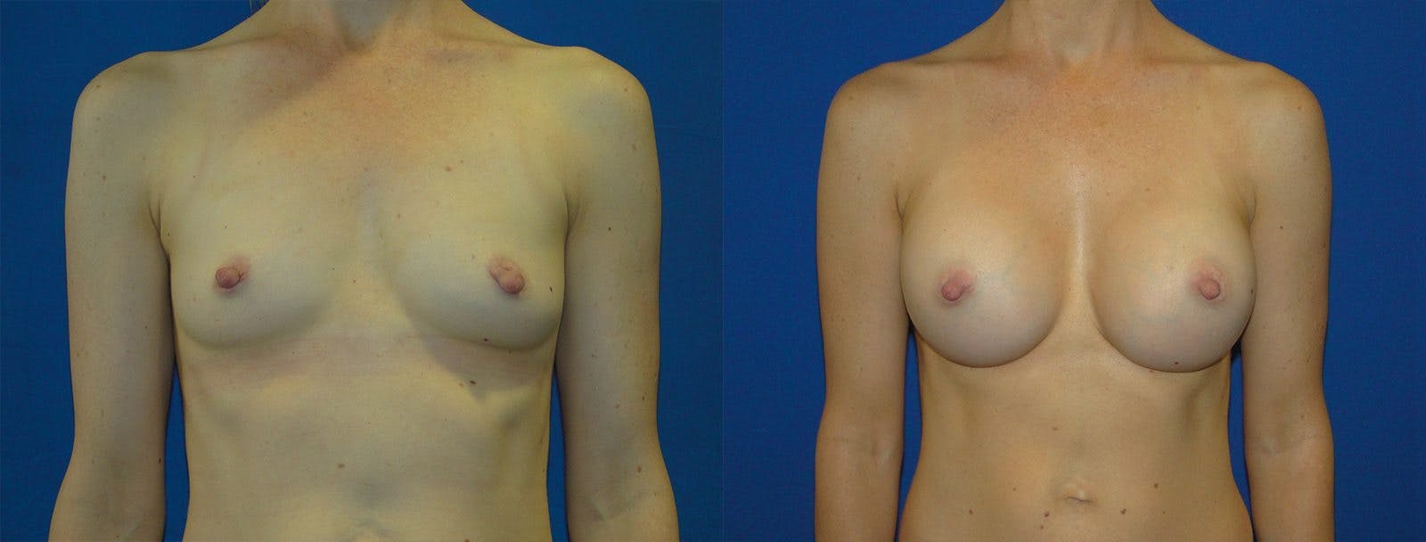 Before And After Breast Augmentation in Orange County - 02