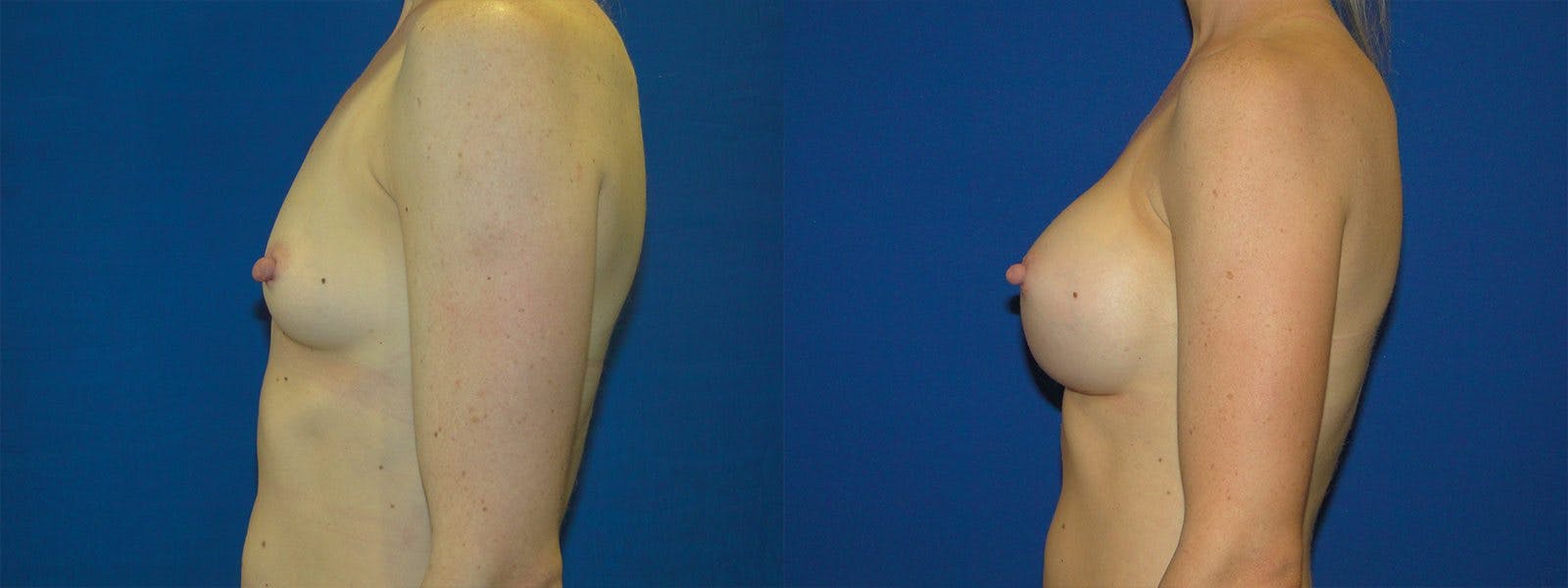 Breast Augmentation Gallery - Patient 74801782 - Image 2
