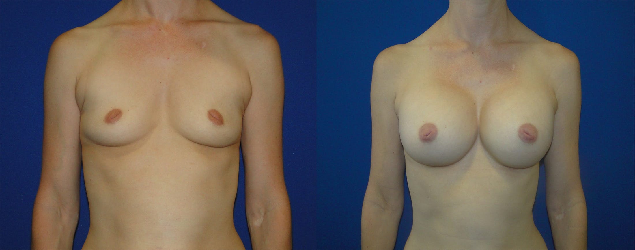 Breast Augmentation Before & After Gallery - Patient 74801787 - Image 1