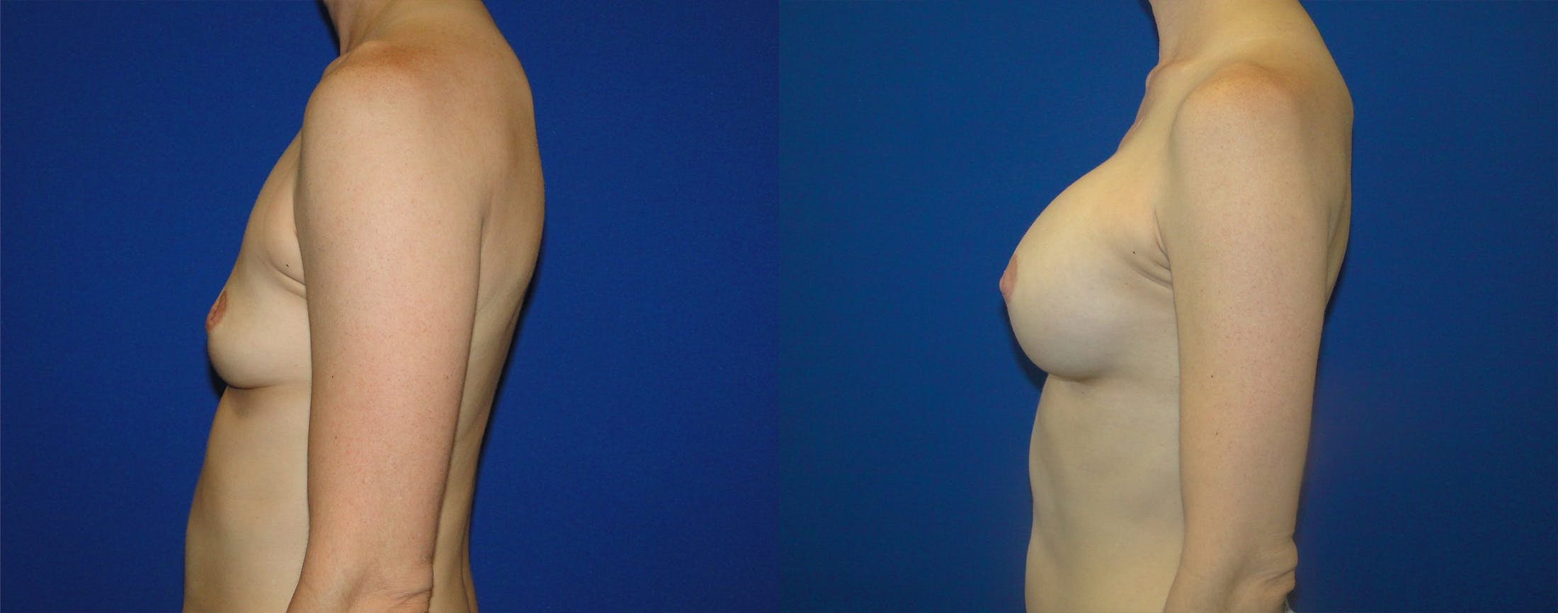 Breast Augmentation Before & After Gallery - Patient 74801787 - Image 2
