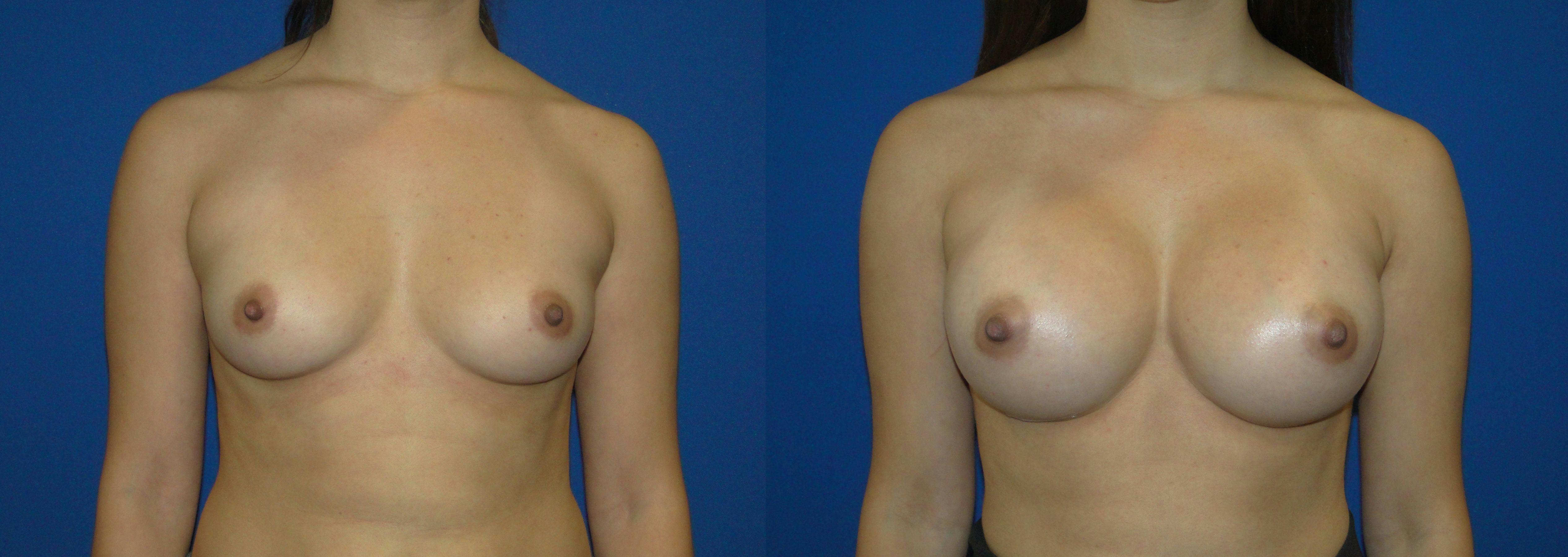 Before And After Breast Augmentation in Orange County - 03