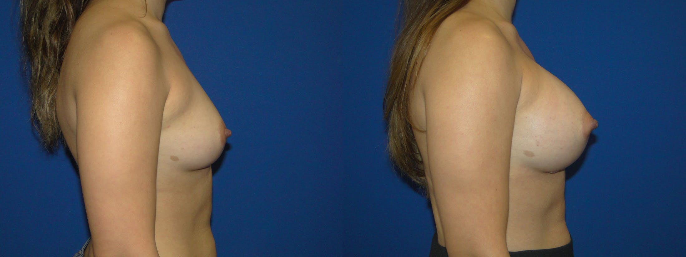 Breast Augmentation Before & After Gallery - Patient 74801788 - Image 2