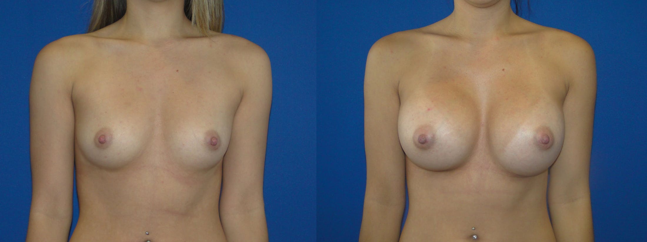 Breast Augmentation Before & After Gallery - Patient 74801789 - Image 1