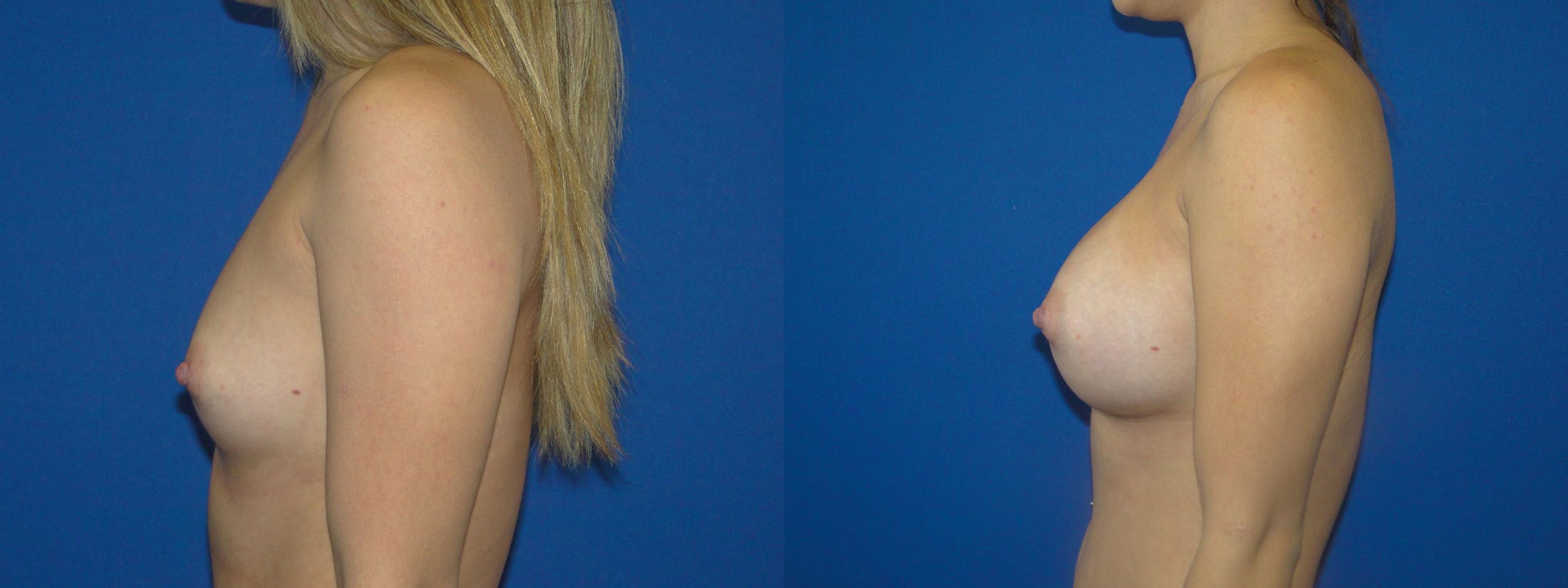 Breast Augmentation Before & After Gallery - Patient 74801789 - Image 2
