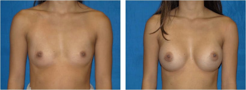 Breast Augmentation Before & After Gallery - Patient 74801790 - Image 1