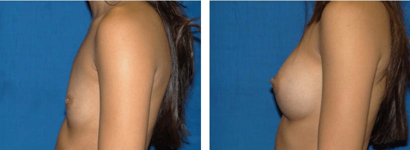 Breast Augmentation Before & After Gallery - Patient 74801790 - Image 2