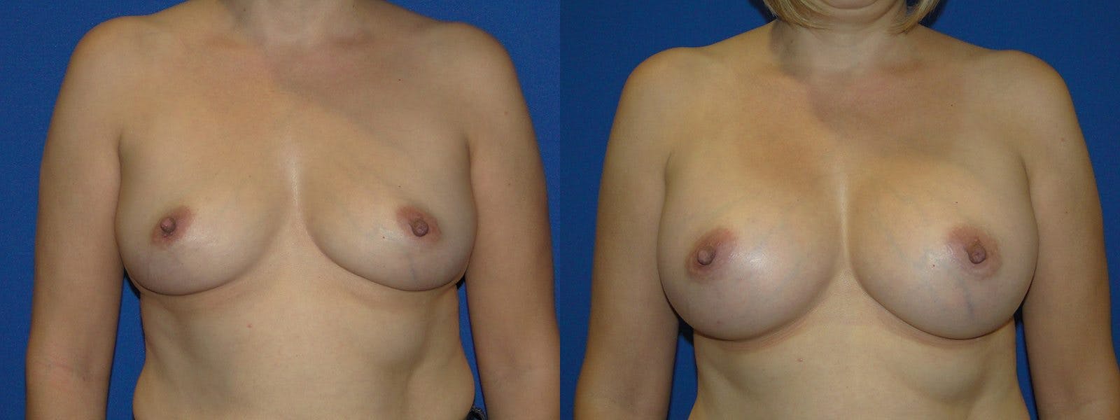 Breast Augmentation Before & After Gallery - Patient 74801791 - Image 1
