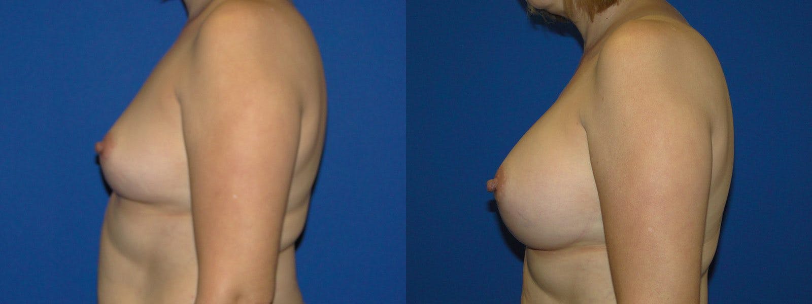 Breast Augmentation Gallery - Patient 74801791 - Image 2
