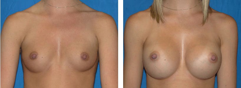 Breast Augmentation Gallery - Patient 74801793 - Image 1