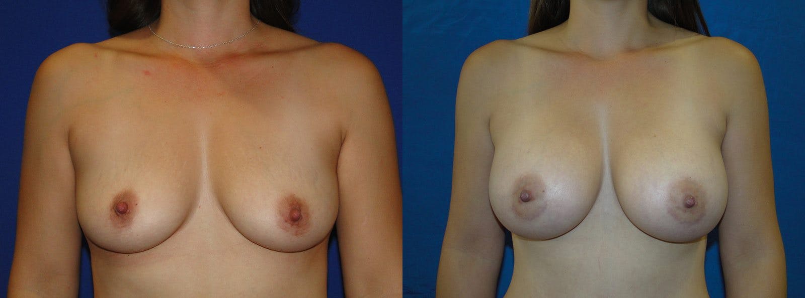 Breast Augmentation Before & After Gallery - Patient 74801794 - Image 1