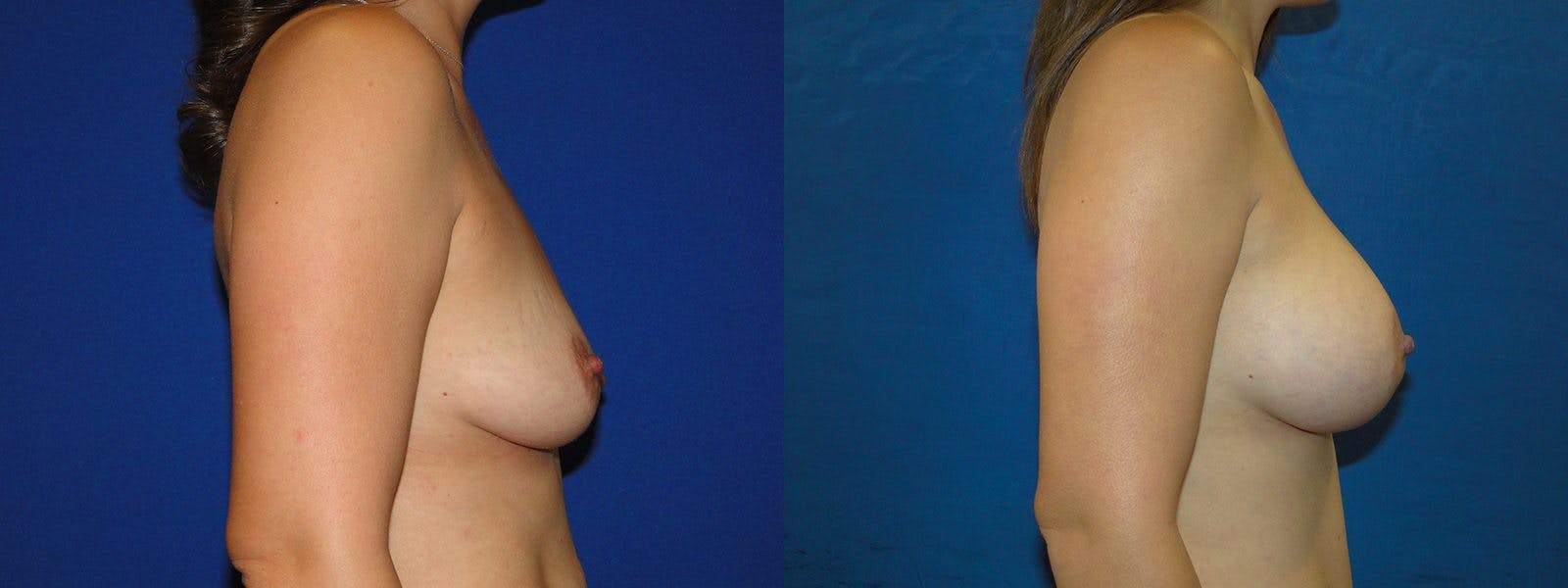 Breast Augmentation Before & After Gallery - Patient 74801794 - Image 2